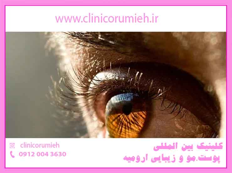 کلینیک بین المللی پوست مو زیبایی ارومیه-هزینه، روش ها و مزایای لیفت چشم بدون جراحی