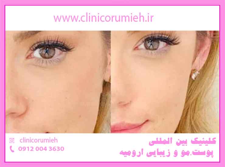 کلینیک بین المللی پوست مو زیبایی ارومیه-هزینه، روش ها و مزایای لیفت چشم بدون جراحی