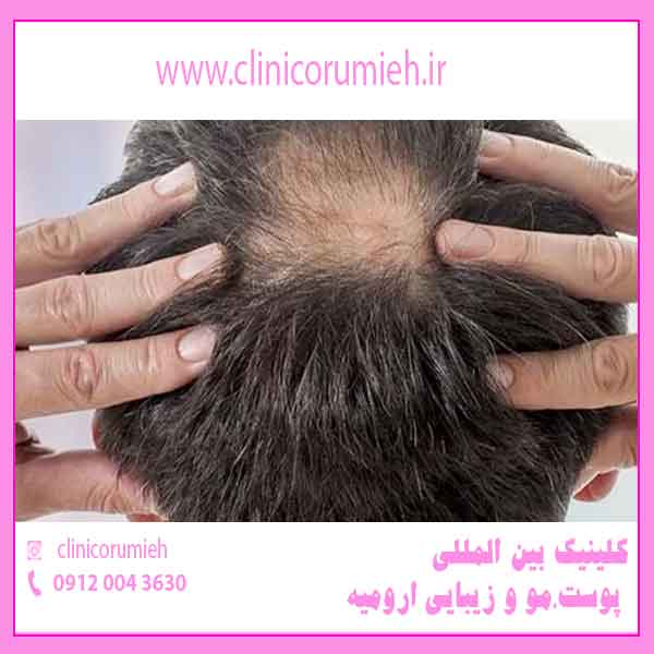 جلوگیری از ریزش مو_راهکارهای موثر در درمان ریزش مو